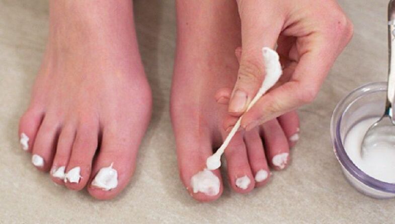 Traditional treatment for nail fungus