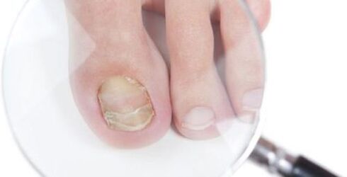Fungus diagnosis