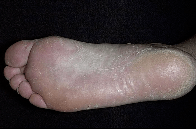 The fungus of the foot