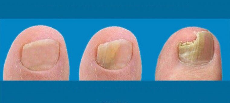 Nail fungal development process