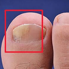 Mycosis or nail fungi