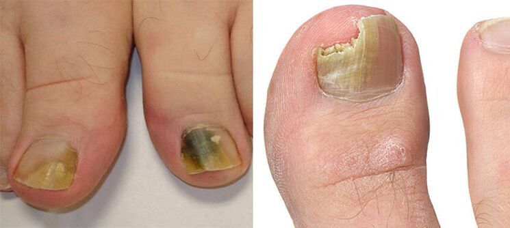Onychomicosis - Destruction of nails with a fungus