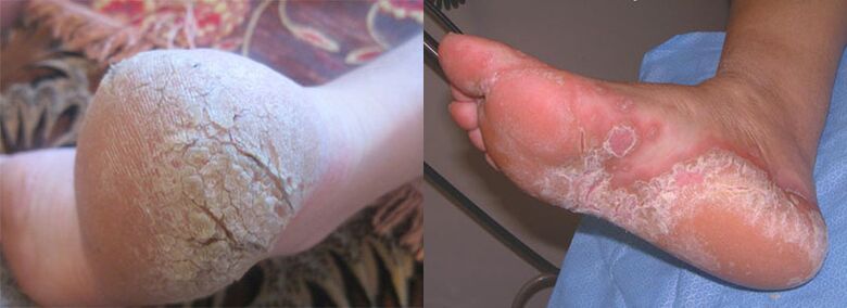 The feet affected by the fungus