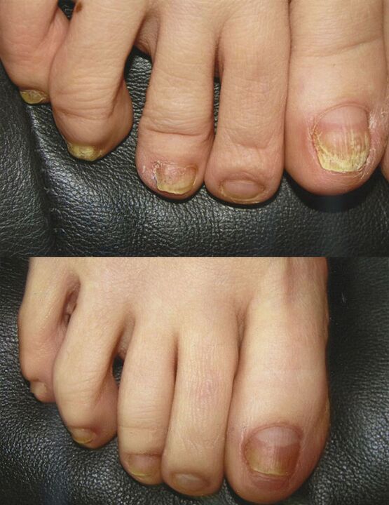 The use of boric acid to treat the fungus