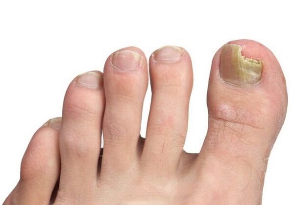 How is the fungus infection