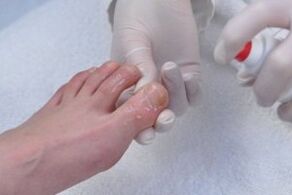 fungal nail treatment