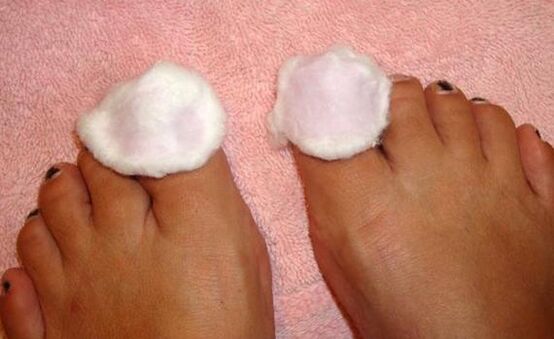 compress for nail fungus treatment