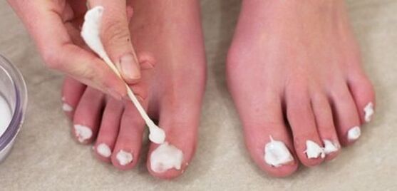 nail fungus treatment with ointment