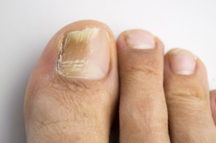Fungal infection in toenails