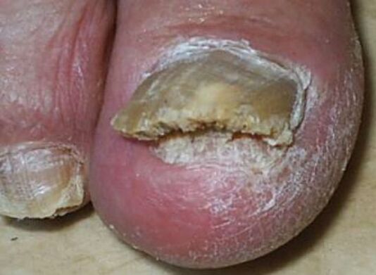 nail fungus photo