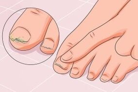 fungal nail infection