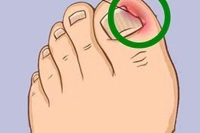 ingrown toenail due to nail fungus
