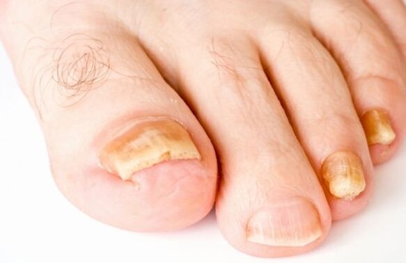 Dystrophic (advanced) stage of onychomycosis