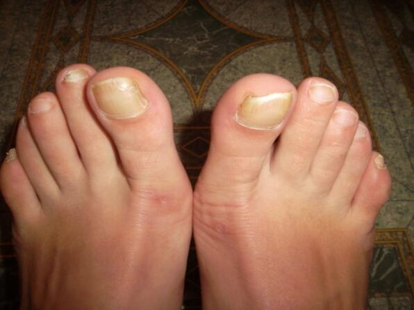 Fungal infection of big toenails