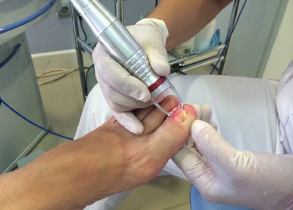 Laser treatment for big toe nail fungus