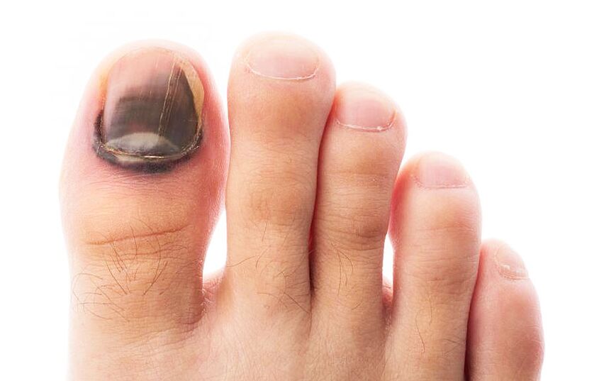 Fungal infection of the nail plate of the toe