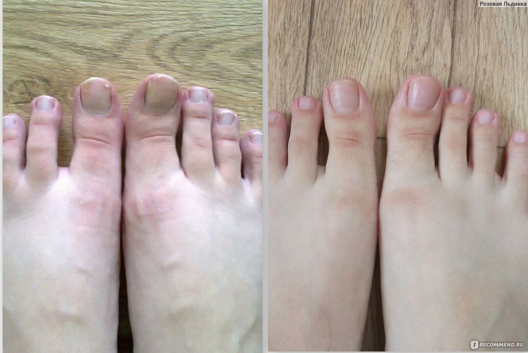 before and after treatment of fungi with Fungostop Plus cream